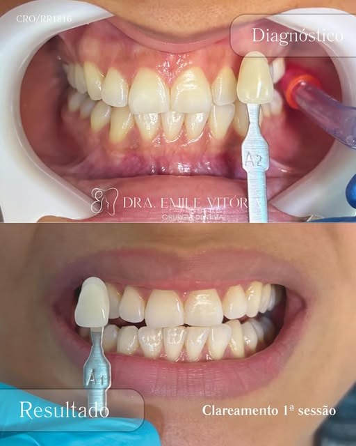 Diagnóstico e resultado de clareamento dental após a primeira sessão, com a escala de cor mostrando dentes mais claros